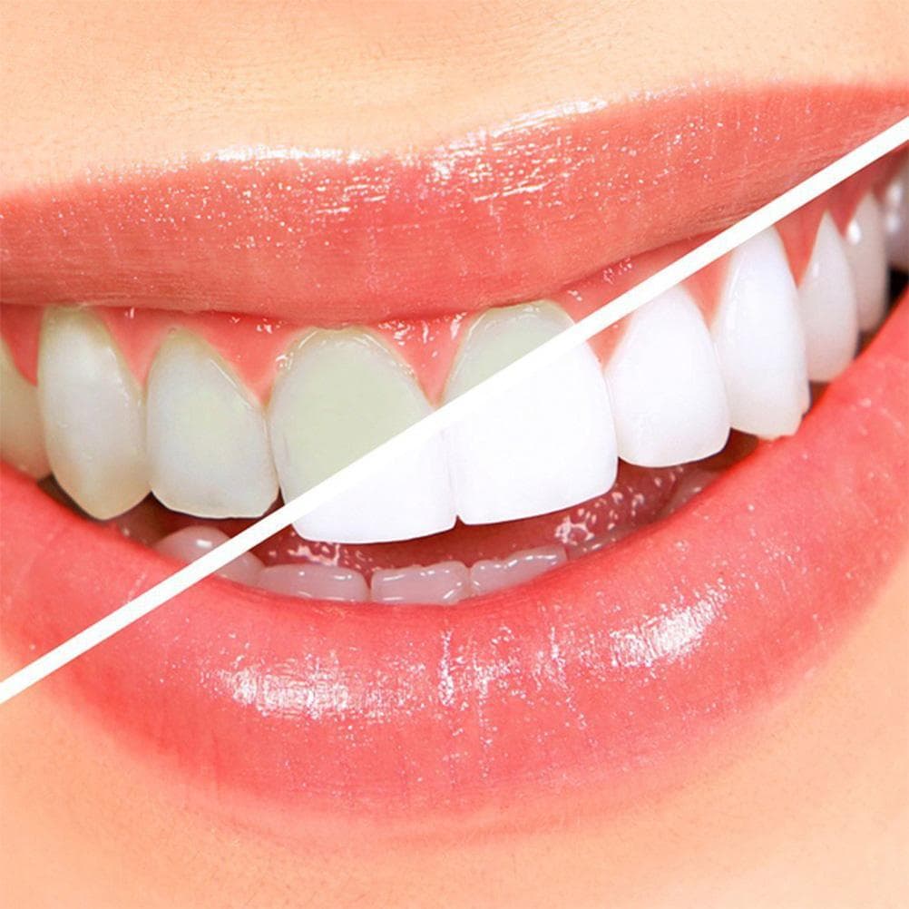 Teeth Whitening Kit Professional Dental Oral Gel Kit Teeth Whitening Dental Equipment