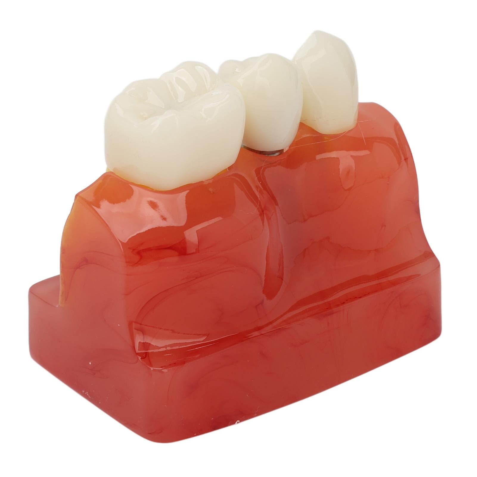 4 Times Dental Implant Model Crown Bridge Implant Teeth Demonstration Model for Doctors Patient