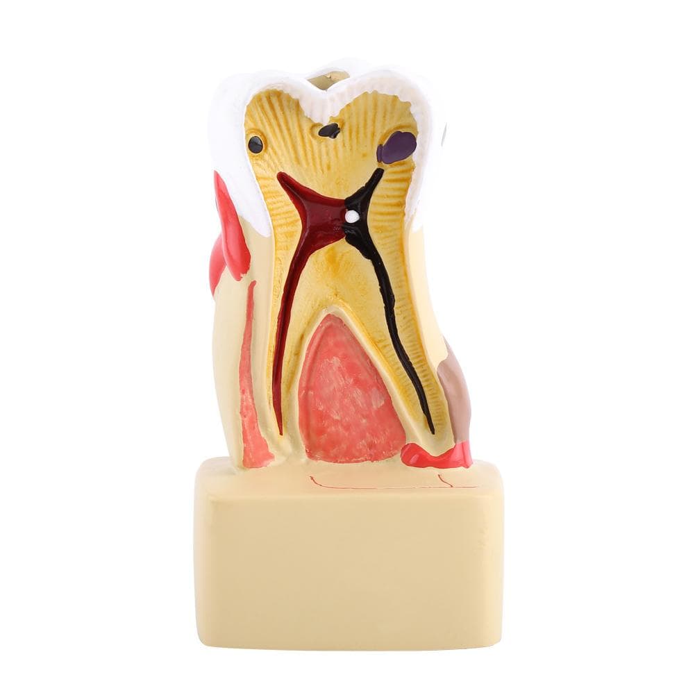 1pc Dental Comprehensive Pathological Disease Caries Study Teaching Tooth Model