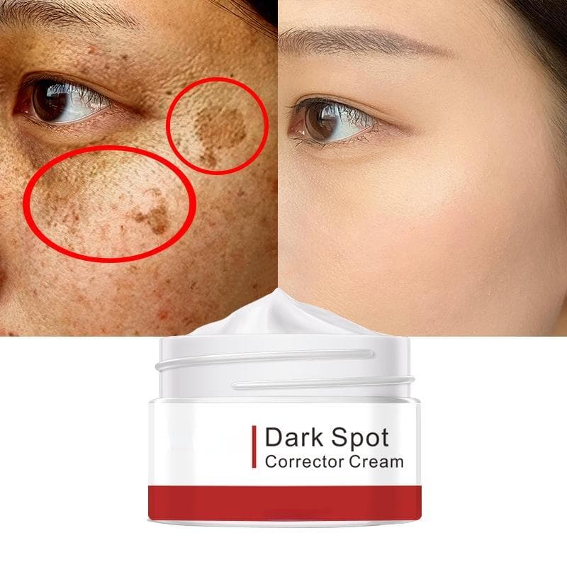 Effective Whitening Freckle Cream Remove Melasma Acne Spot Pigment Melanin Dark Spots Pigmentation Moisturizing Gel Skin Care 50G