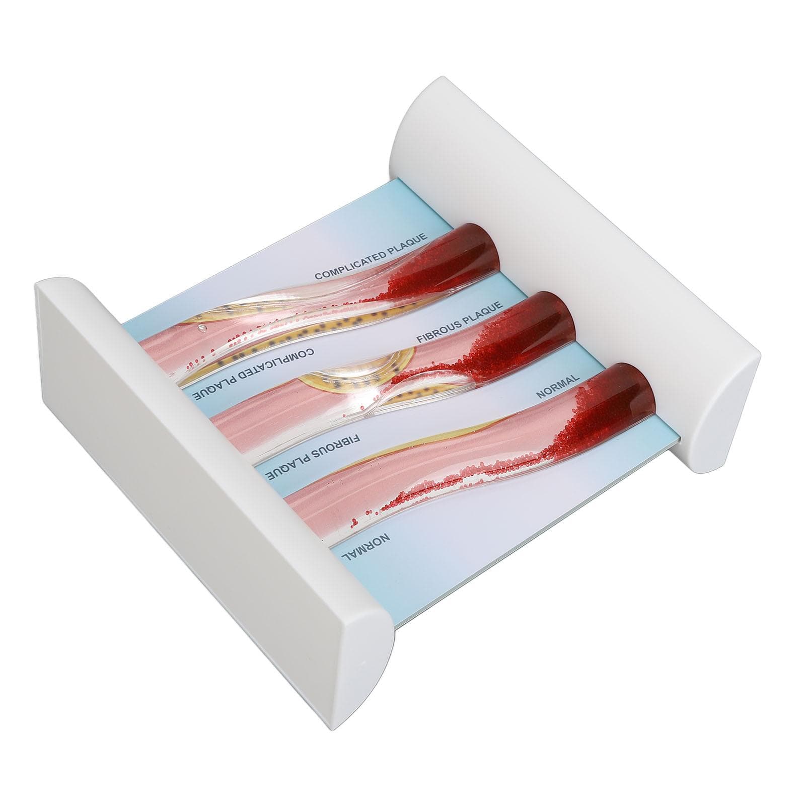 Lipoprotein LDL Blood Vessel Model Low Density Blood Lipid Vessel Obstruction Model for Education