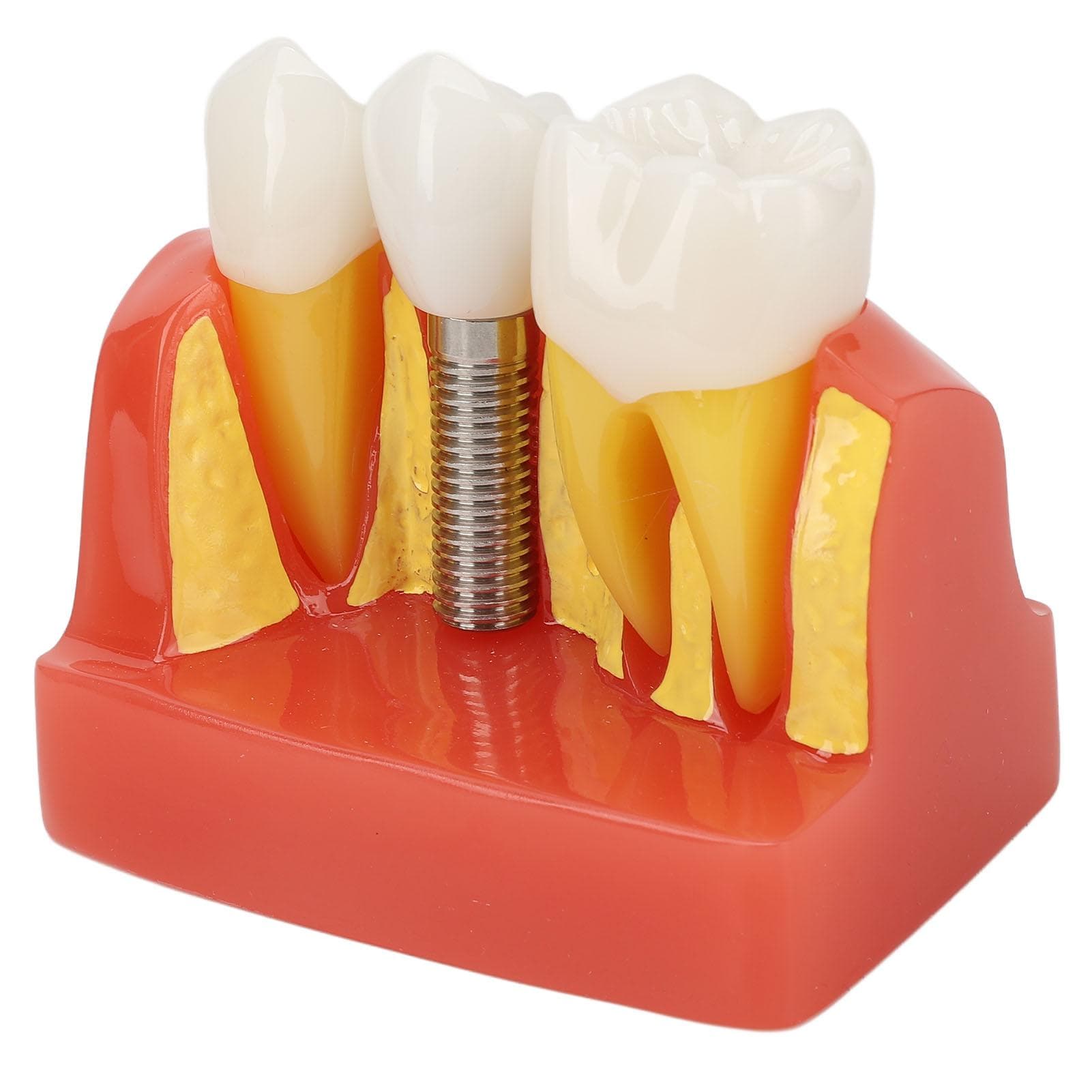 Dental Implant Model Removable Analysis Crown Bridge Demonstration Tooth Model Education Learning