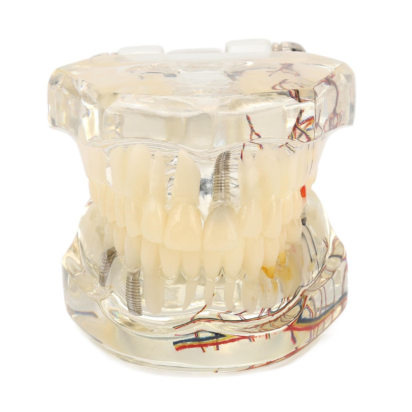 Transparent Dental Implant Pathological Model Implant Disease Teeth Model for Teaching