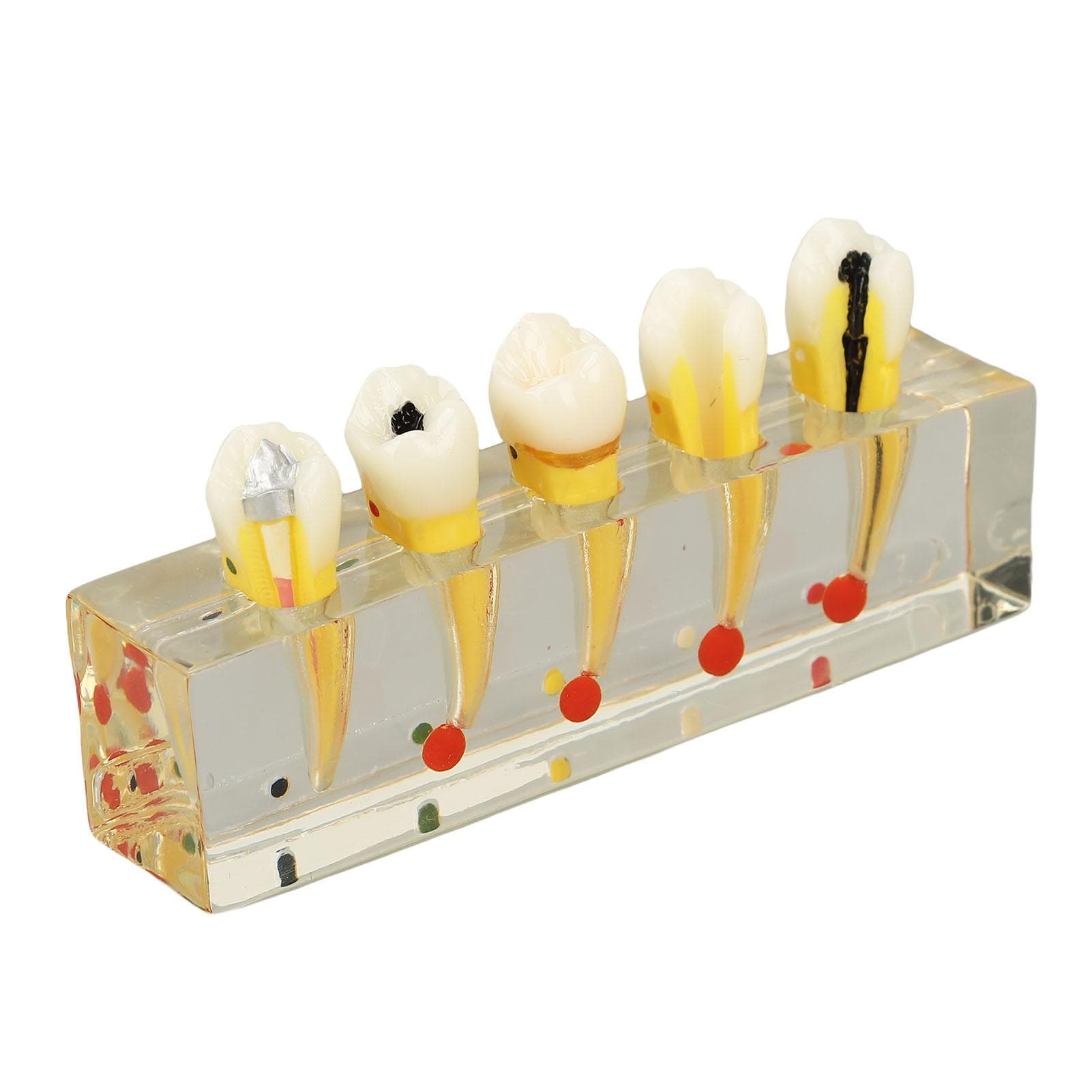 Teeth Model Dental Study Transparent Implant Dental Caries Model for Dental Teaching