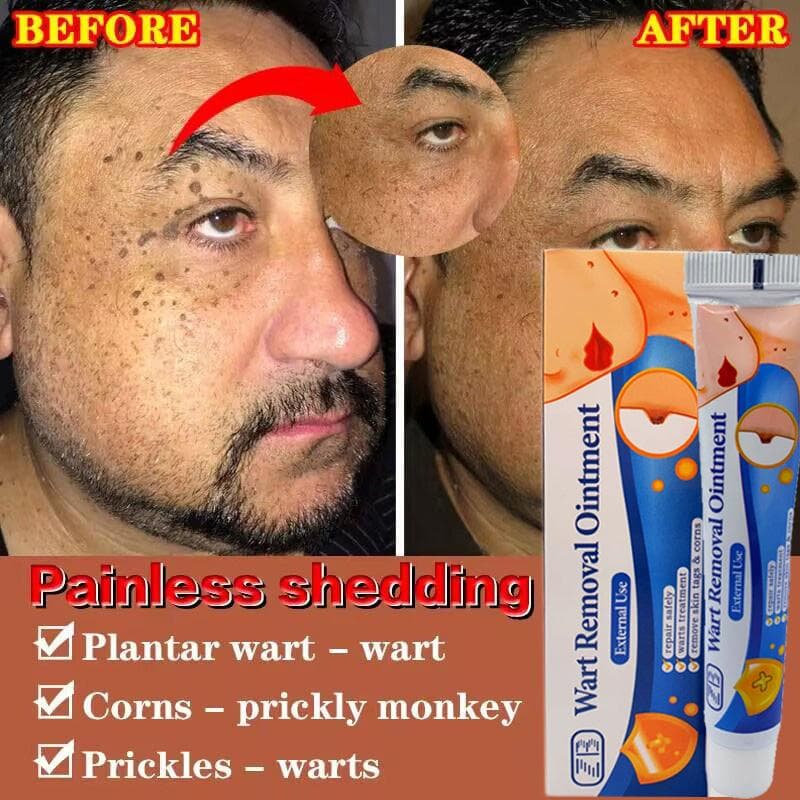 Corns and Moles Hair Removal Cream