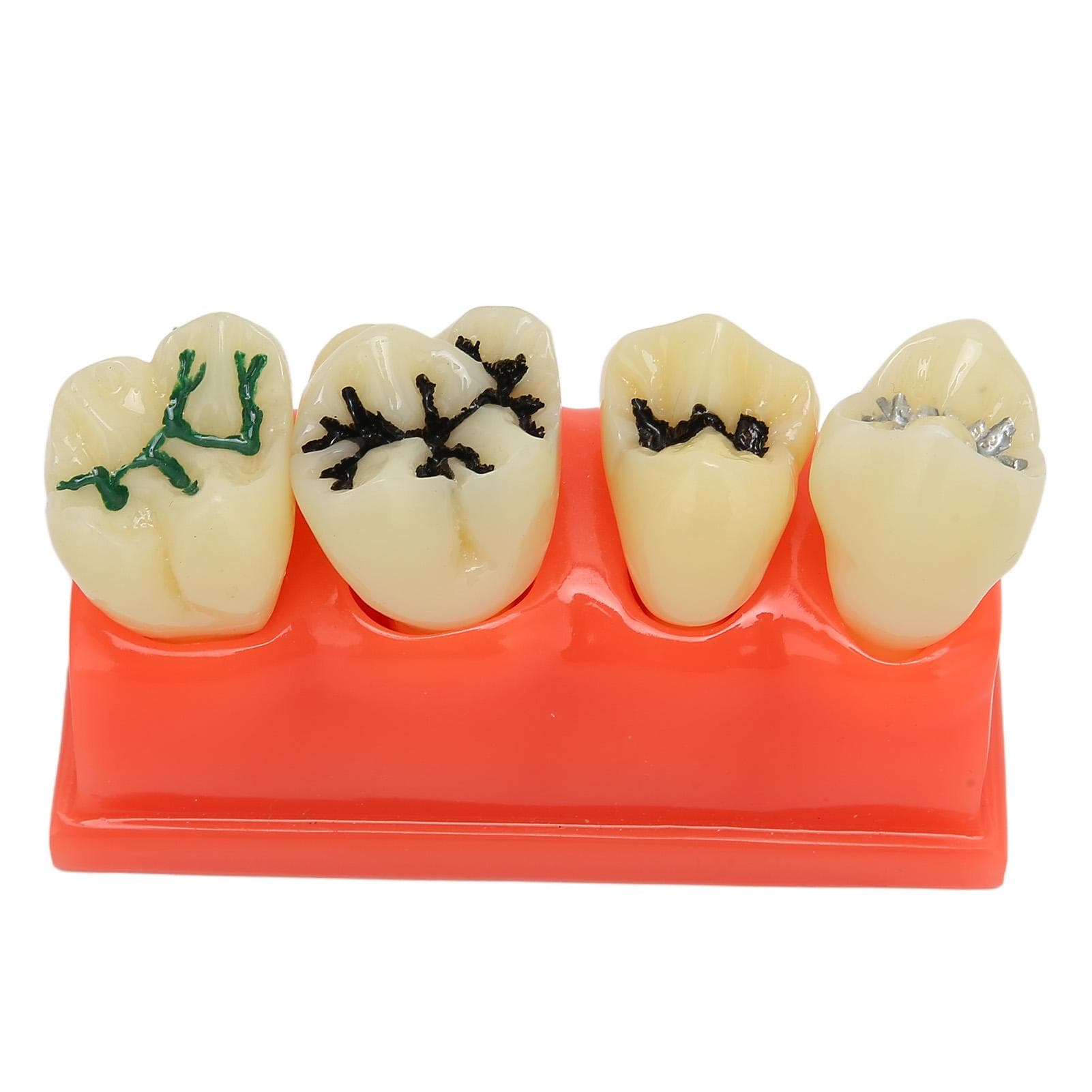 Dental Caries Model Resin 4 Teeth Oral Care Educational Decayed Tooth Display Model for Dental