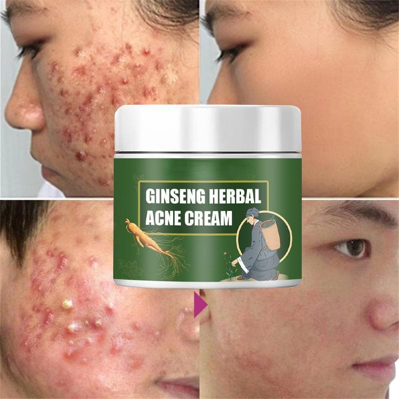 Effective Acne Removal Cream Treatment Acne Scar Shrink Pores Oil Control Whitening Moisturize Face 15g