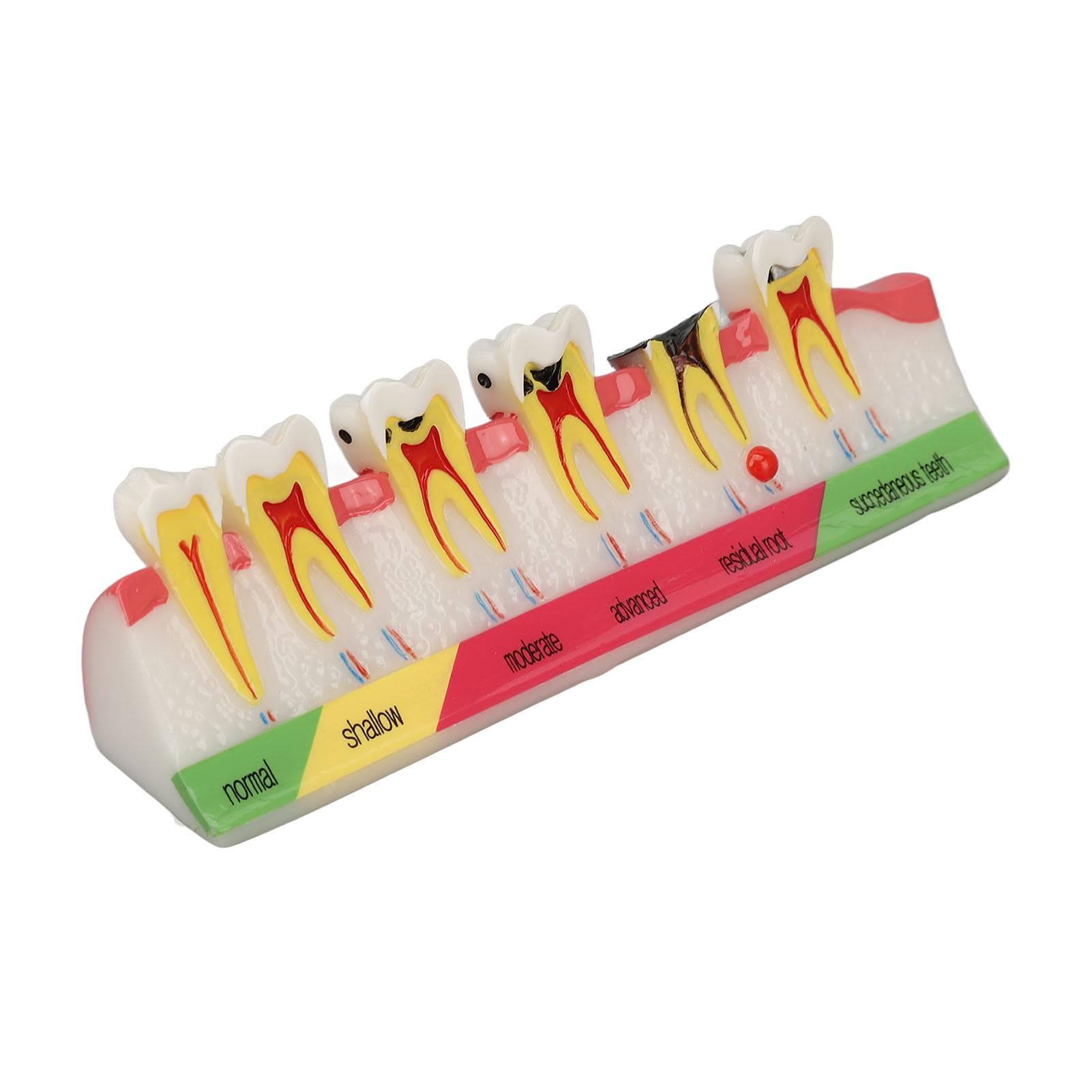 Dental Caries Model 6 Different Stages Resin Decayed Tooth Display Model