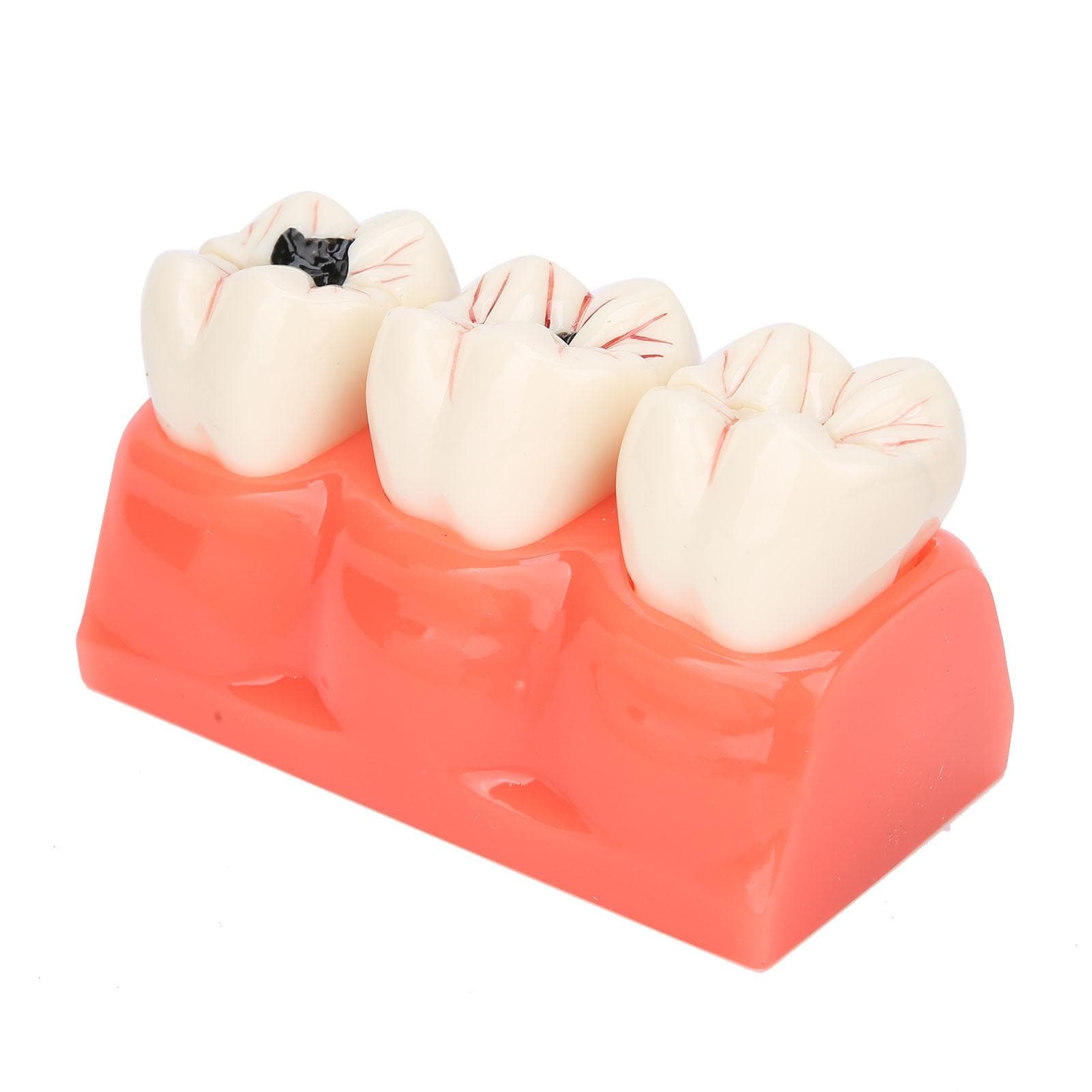 Dental Caries Model Tooth Decay Demonstration Model Simulation Detachable Teeth Model