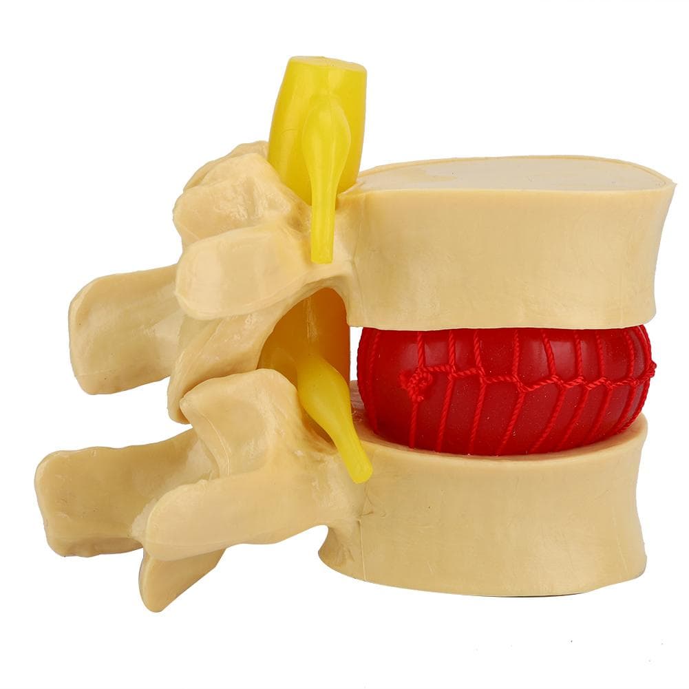 1:1.5 Lumbar Disc Herniation Demonstration Model Study Learn Human Spine